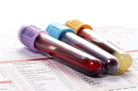 anti beta 2 glycoprotein|The Significance of Anti.